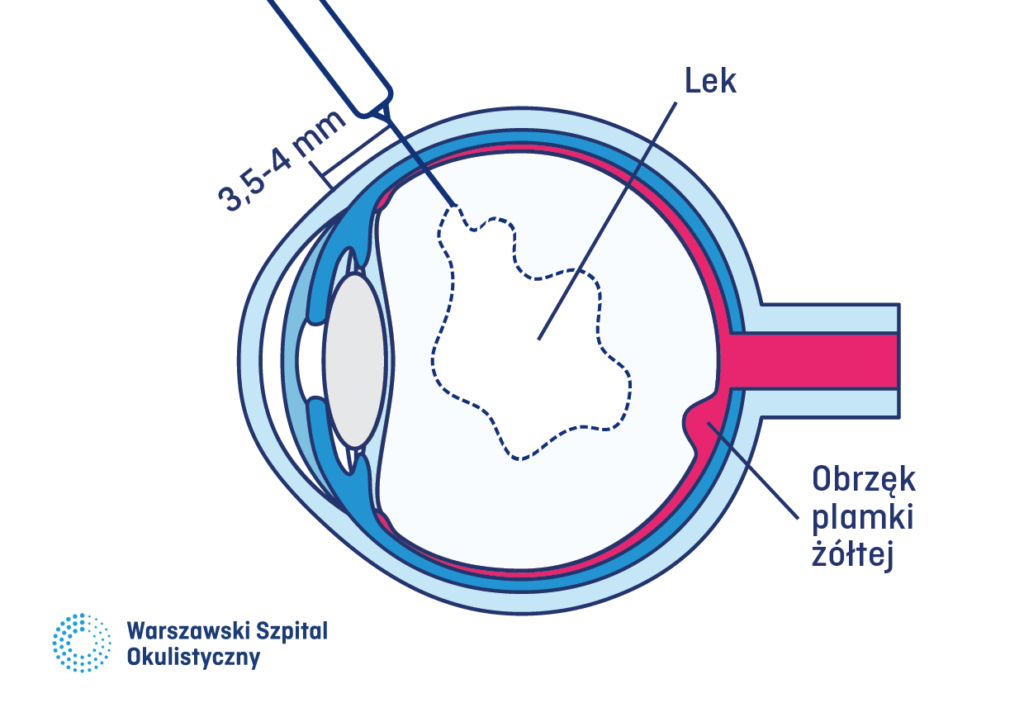 Oko chore - leczone. Zastrzyk do oka. Plamka żółta z obrzękiem