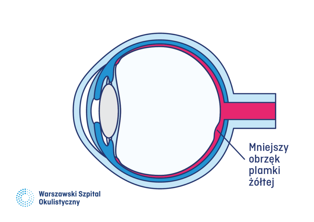 Oko po leczeniu. Mniejszy obrzęk plamki żółtej