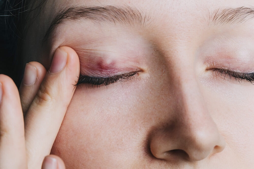 Jak leczyć gradówkę na oku? Skuteczne metody i porady