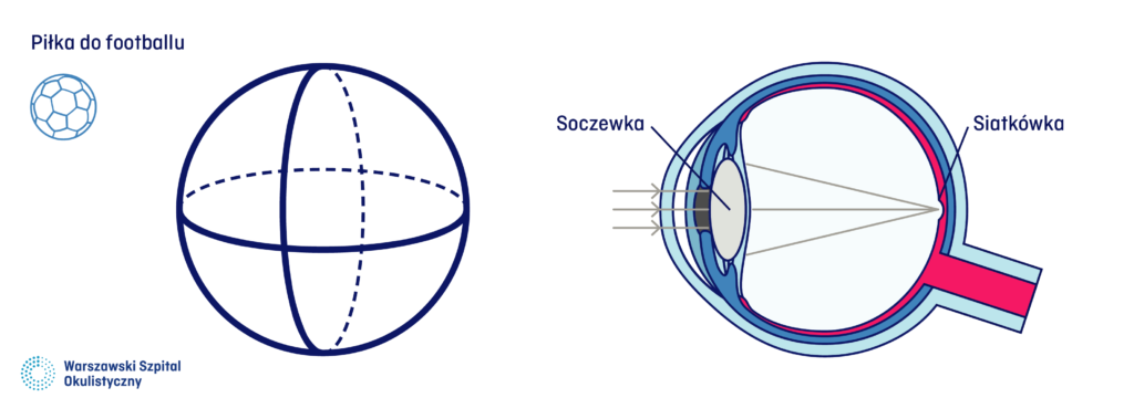 W oku bez wady astygmatyzmu rogówka jest fragmentem kuli.