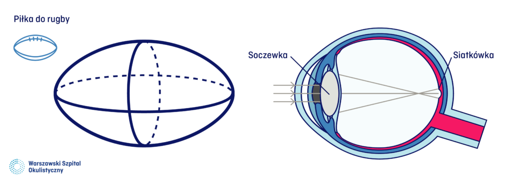 W przypadku astygmatyzmu powierzchnia rogówki przypomina powierzchnię piłki do rugby.