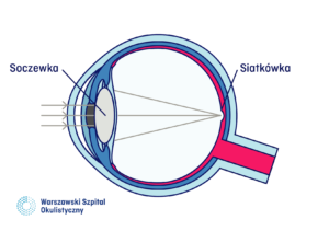 Oko prawidłowej budowy. Promienie skupiają się na siatkówce.