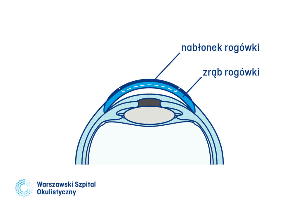 1) Technika Lasik. Odcięcie płatka rogówki