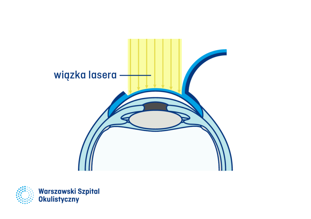 3) Technika Lasik. Odcięcie płatka rogówki