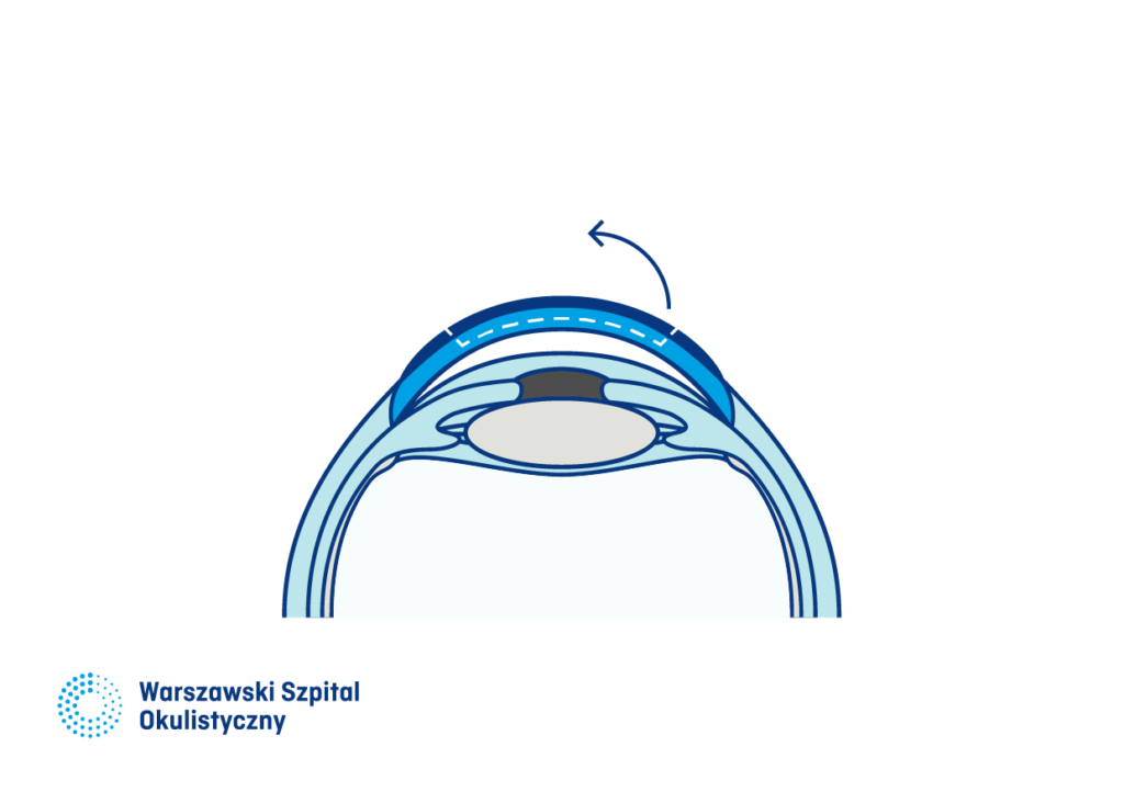 4) Technika Lasik. Nałożenie płatka rogówki