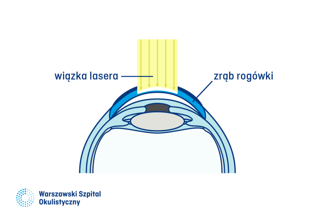 1) Technika SMILE. Laser wycina fragment istoty właściwej rogówki