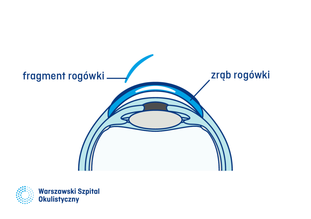 2) Technika SMILE. Fragment jest usuwany. Kształt usuwanej części jest specjalnie dobrany w zależności od wady wzroku